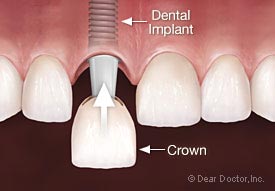 Dental Implants