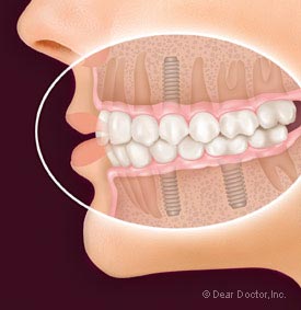 Dental Implants